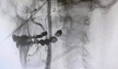 Manisa Şehir Hastanesi’nde felç riskine karşı ameliyatsız çözüm
