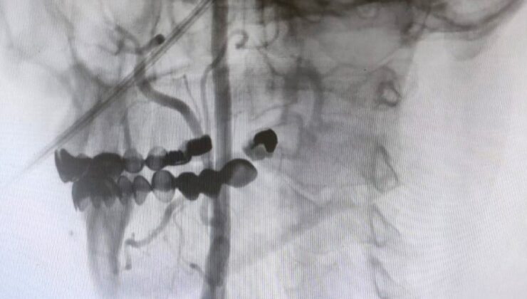 Manisa Şehir Hastanesi’nde felç riskine karşı ameliyatsız çözüm